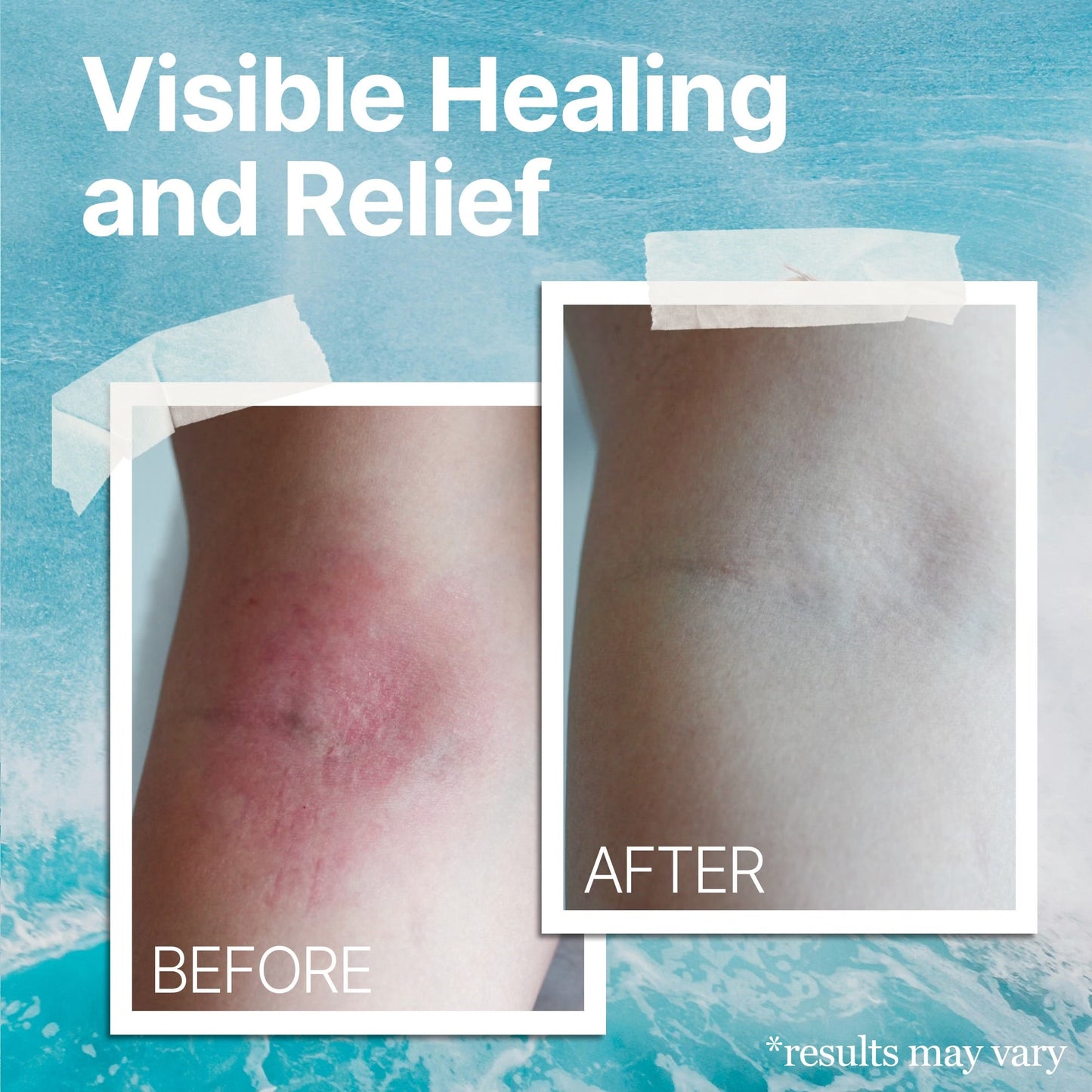 The Ocean Healed My Eczema